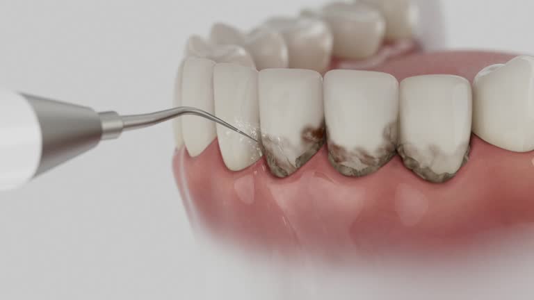 Trusted Wisdom Tooth Removal service in Bessemer, AL - Dentist Open Now